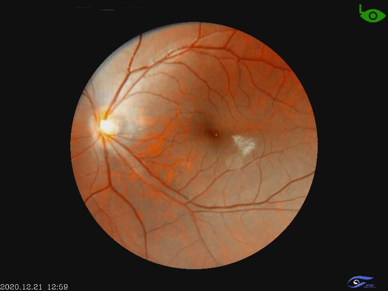 Ophthalmic Portable Hand-Held Fundus Camera Equipment Instrument