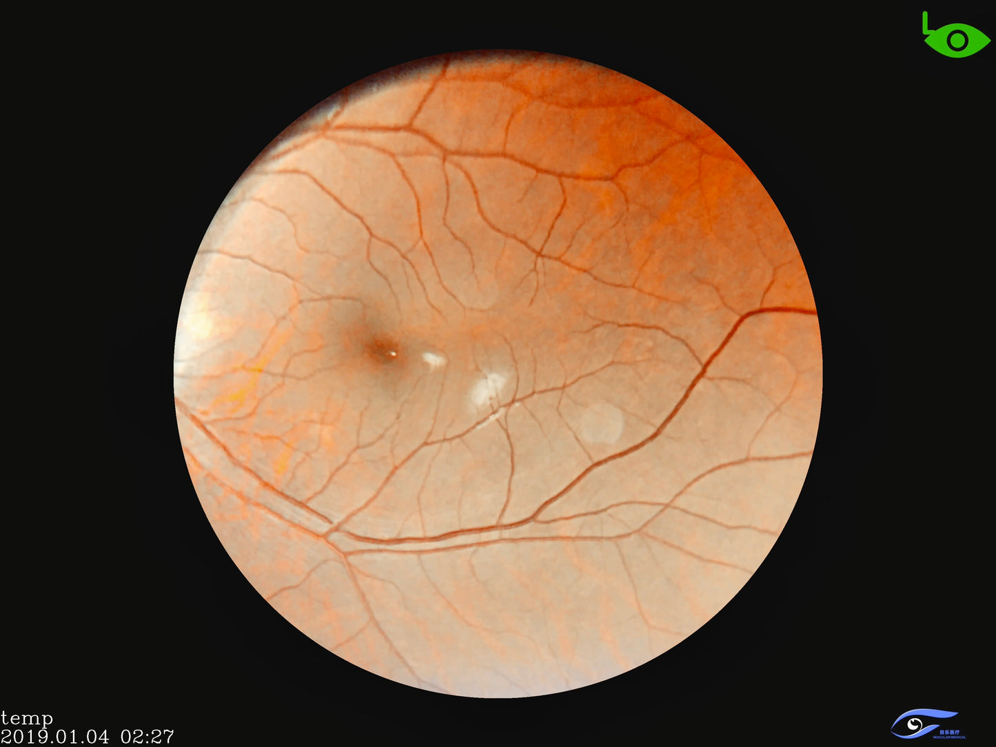 Ophthalmic Portable Hand-Held Fundus Camera Equipment Instrument