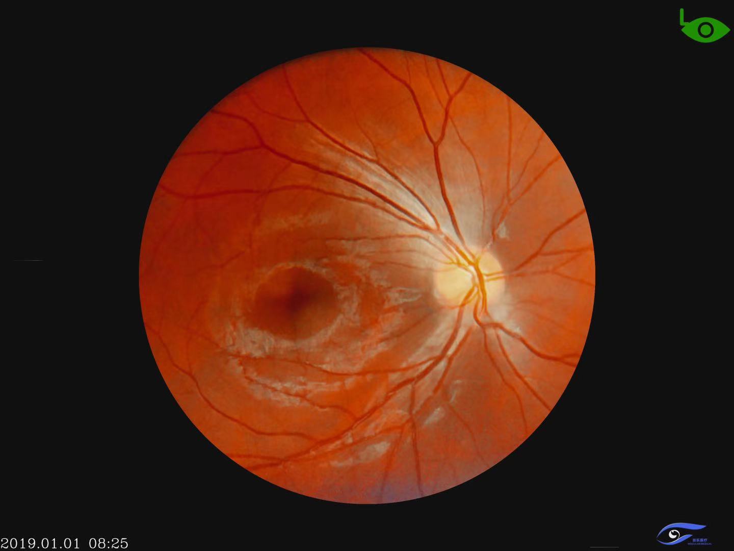 Ophthalmic Portable Hand-Held Fundus Camera Equipment Instrument